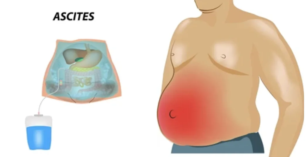 understanding-ascites-anatomy-causes-diagnosis-and-management